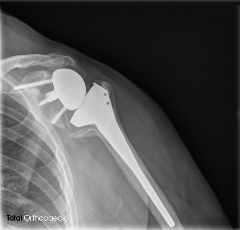 The Root of the Problem: Understanding What Causes Rotator Cuff Injuries