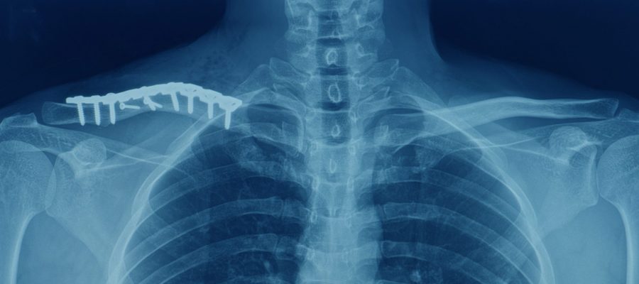 An,Anteroposterior,X-ray,Of,Both,Clavicle,Fracture,Of,Right,Clavicle