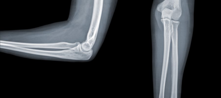 X-ray elbow